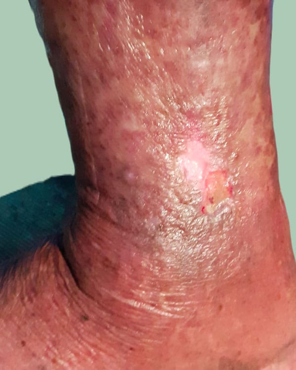 Ulcère veineux sur une jambe