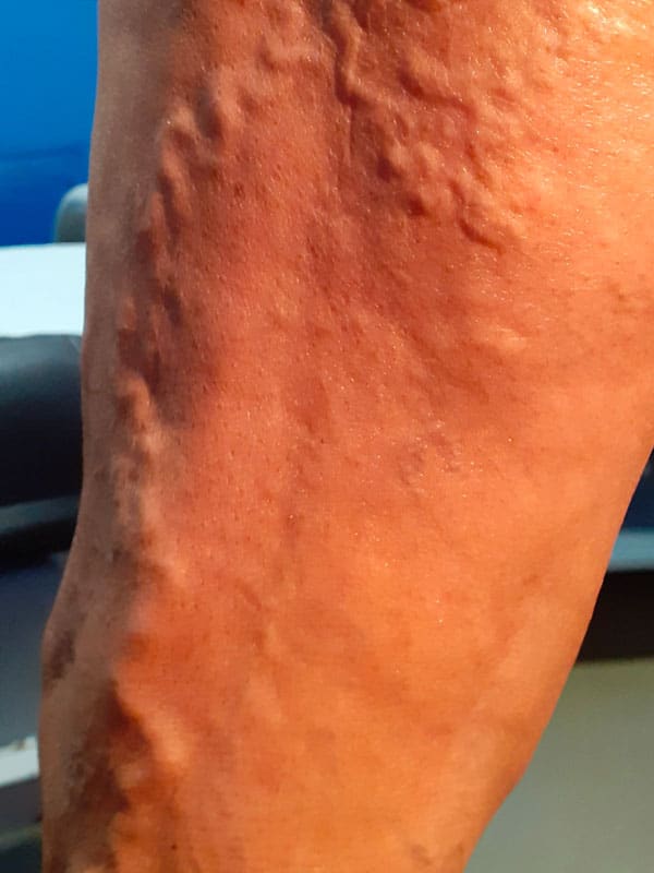 varices de gros calibre